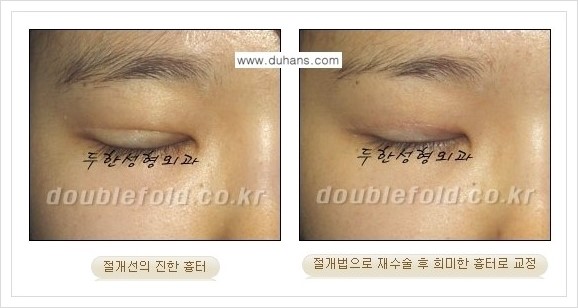 [두한성형외과 경쟁력 쌍꺼풀 재수술, 극한 재수술] - [망가진 눈 복원수술 - 흉터선이 진한 경우 교정 안내] 관련 이미지 3