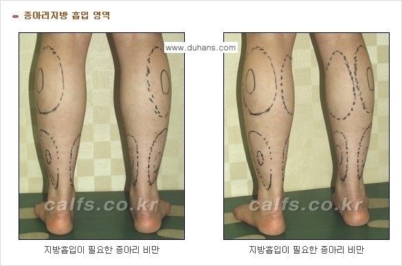 ⁠⁠[두한성형외과 경쟁력 멀티종아리성형] - [지방흡입이 필요한 종아리 비만 안내] 관련 이미지 3
