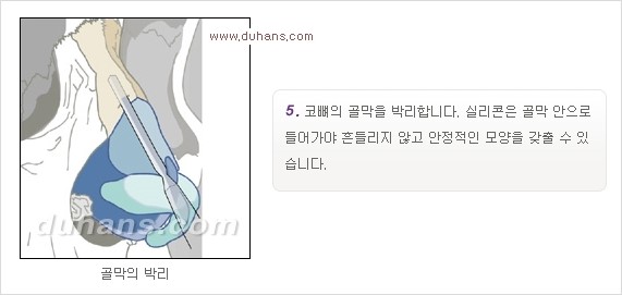 [두한성형외과 경쟁력 코성형] - [코성형을 위한 알로덤(슈어덤) 수술, 실리콘 수술 안내] 관련 이미지 23
