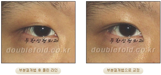 [두한성형외과 쌍커풀수술] - [눈성형 방법에 대한 자주하는 질문과 답변] 관련 이미지 54