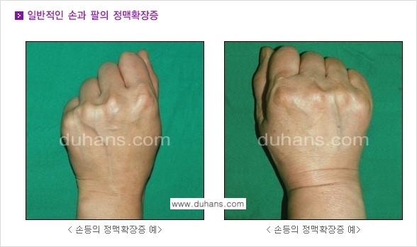 [두한성형외과 정맥 혈관 확장으로 인한 피부개선] - [손, 팔 혈관 확장] 관련 이미지 2