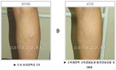 ​[두한성형외과 종아리수술] - [나에게 맞는 종아리성형방법] 관련 이미지 47