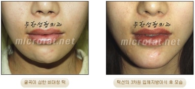 [Duhan Plastic Surgery Clinic Microgenia Correction] - [Chin Microfat Grafting] image 21