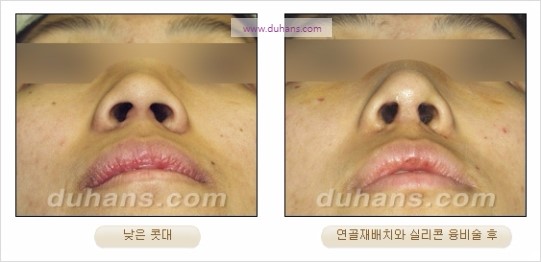 ​[두한성형외과 경쟁력 코성형] - [코성형을 위한 안전하고 효과적인 실리콘 수술] 관련 이미지 18