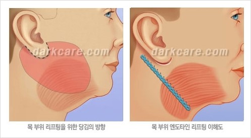 [두한성형외과 경쟁력 주름성형] - [주름제거를 위한 리프팅] 관련 이미지 18