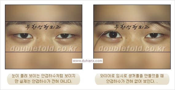 [두한성형외과 경쟁력 쌍꺼풀 재수술, 극한 눈재수술] - [안검하수(졸린 눈매)의 종류 안내] 관련 이미지 4