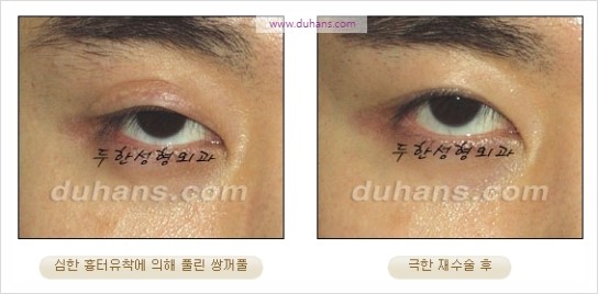 [두한성형외과 경쟁력 눈성형] - [쌍꺼풀 재수술에 대한 최선의 대안 제시] 관련 이미지 56