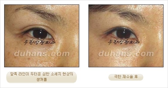 [두한성형외과 경쟁력 쌍꺼풀 재수술 리더 ] - [쌍꺼풀 재수술 과정, 쌍꺼풀 재수술 실패의 원인, 극한 재수술] 관련 이미지 4