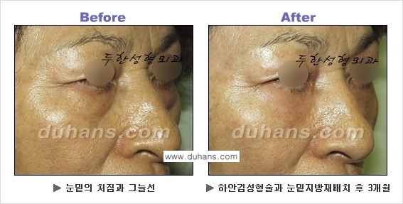 [두한성형외과의 상큼하고 환한 젊은 눈매완성] - [하안검 성형술 ②] 관련 이미지 25