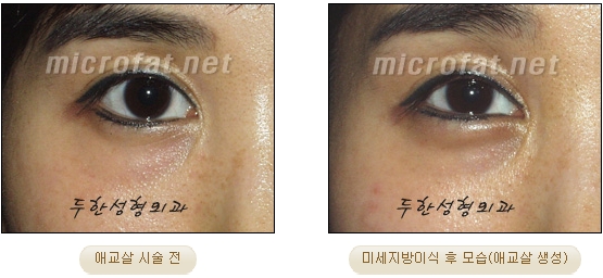 Duhan Plastic Surgery Under-Eye Surgery - Correction with Fat Grafting After Aegyo-Sal Filler image 26