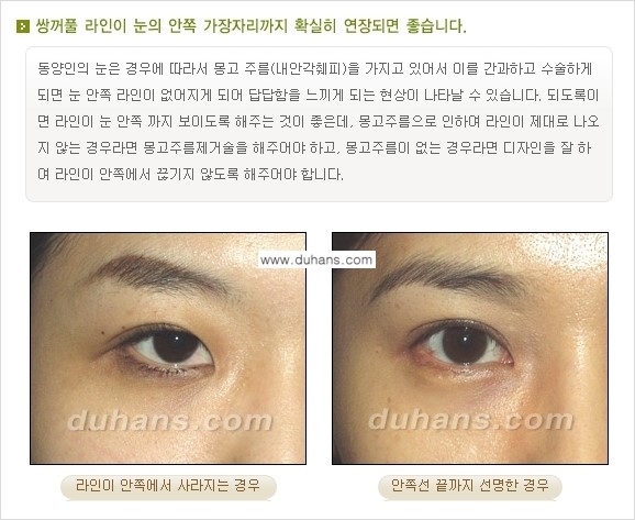 [두한성형외과 경쟁력 눈성형] - [매력적인 쌍꺼풀이란?] 관련 이미지 3