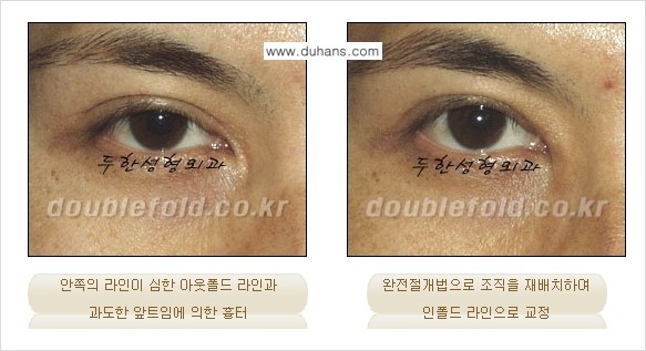 [두한성형외과] - [아웃폴드를 인폴드로 변화시키는 쌍꺼풀재수술] 관련 이미지 5