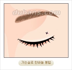 ⁠⁠[두한성형외과 경쟁력 안검성형] - [젊은 눈매를 위한 윗눈꺼풀 지방제거, 눈밑 지방제거] 관련 이미지 9