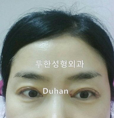 [두한성형외과 쌍커풀재수술] - [심한 소세지눈, 두줄따기, 쌍꺼풀 흉터] 관련 이미지 2