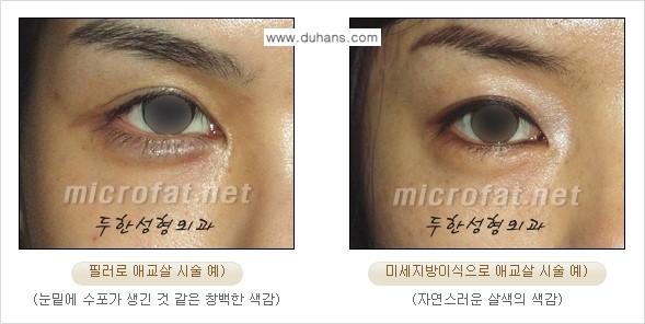 [두한성형외과 무한 경쟁력 눈밑성형] - [애교살 시술 2.] 관련 이미지 4
