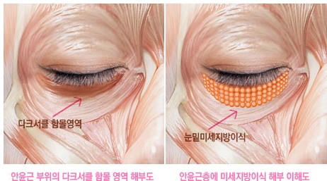 [두한성형외과 다크서클] - [콜펫지방이식] 관련 이미지 15