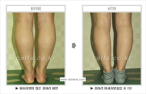 [두한성형외과 매력적인 종아리 만들기!] - [정교한 흡입 - 미세흡입관 지방흡입술 3.] 관련 이미지 5