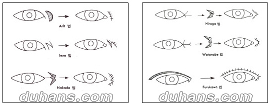 [Duhan Plastic Surgery Double Eyelid Surgery] - [Types of Double Eyelid Surgery] image 30