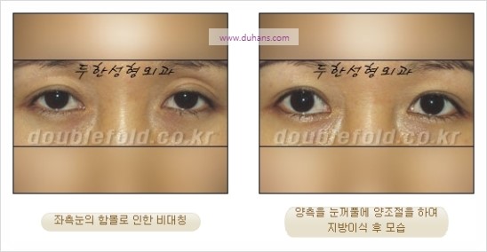 [두한성형외과 경쟁력 눈성형] - [쌍꺼풀 재수술 과정과 쌍꺼풀 재수술 실패의 원인, 쌍꺼풀 재수술의 성공 요건] 관련 이미지 47