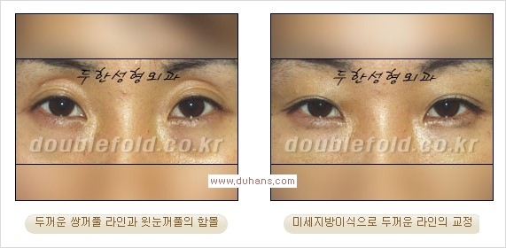 [두한성형외과 경쟁력 쌍꺼풀 재수술] - [쌍꺼풀 재수술 과정] 관련 이미지 90