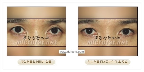 [두한성형외과의 경쟁력 미세지방이식] - [꺼진 눈꺼풀(윗눈꺼풀 함몰) 미세지방이식 안내] 관련 이미지 6