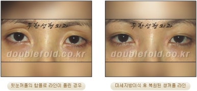 [두한성형외과 쌍커풀수술] - [쌍꺼풀지방이식] 관련 이미지 37