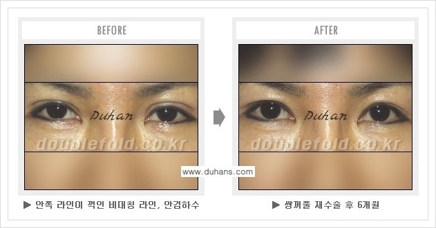 [두한성형외과 경쟁력 쌍꺼풀(눈) 재수술] - [쌍꺼풀 재수술시 잘못된 수술로 인한 넓어진 흉터 처리 안내] 관련 이미지 6