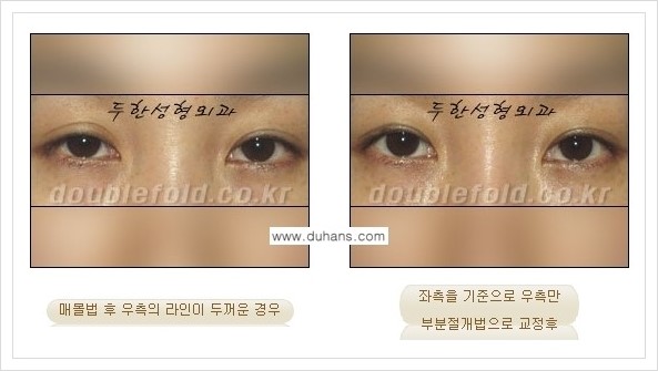 [두한성형외과 경쟁력 눈성형] - [짝짝이(비대칭) 쌍꺼풀 라인 교정하는 방법 안내 1.] 관련 이미지 3