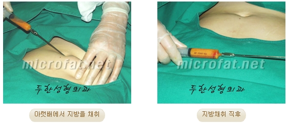 두한성형외과 눈밑성형 - 애교필러 후 눈밑재수술 관련 이미지 11