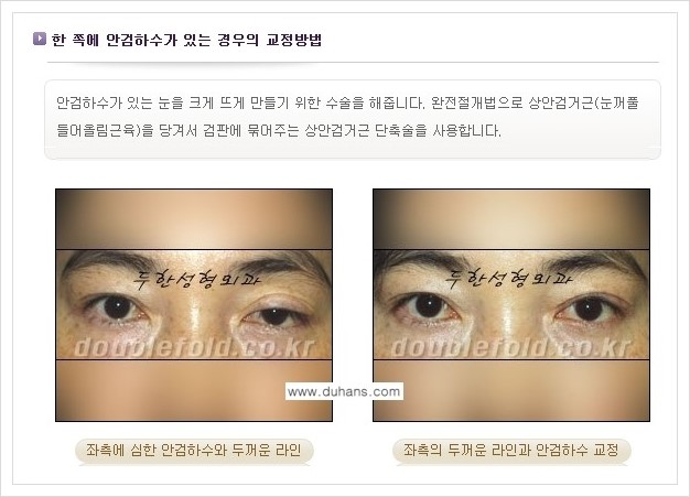 [두한성형외과 경쟁력 눈성형] - [짝짝이(비대칭) 쌍꺼풀 라인 교정하는 방법 안내 1.] 관련 이미지 9