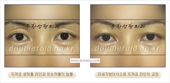 [두한성형외과 경쟁력 쌍꺼풀 재수술] - [쌍꺼풀 재수술 과정] 관련 이미지 95