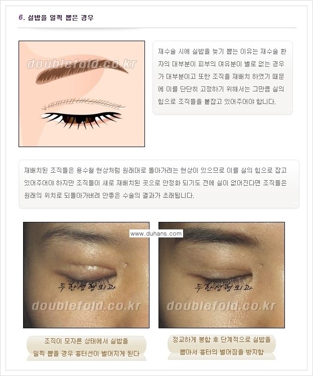 [두한성형외과 경쟁력 쌍꺼풀 재수술, 극한 재수술] - [쌍꺼풀 재수술 실패 원인(Cause of reoperation fail) 안내] 관련 이미지 6