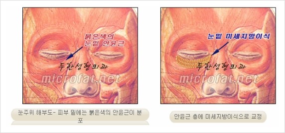 [두한성형외과 경쟁력 눈밑성형 리더] - [윗눈꺼풀 지방제거, 눈밑지방제거, 눈밑지방재배치, 눈밑지방이식 안내] 관련 이미지 14