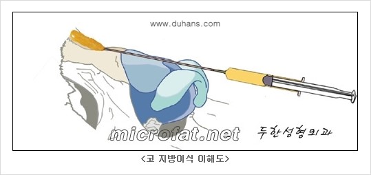 [두한성형외과의 No.1 경쟁력 미세(자가)지방이식] - [코높힘 미세(자가)지방이식 ①] 관련 이미지 2