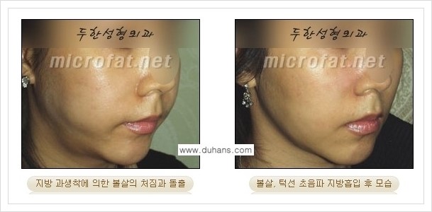 [두한성형외과 겨울엔 지방흡입을] - [볼살, 눈밑, 턱선의 초음파 미세지방흡입 1.] 관련 이미지 13