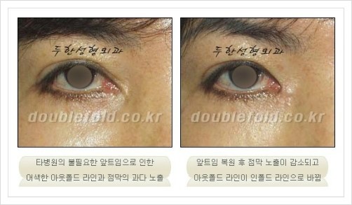 [두한성형외과 경쟁력 눈성형] - [쌍꺼풀 재수술 재상자에 필요한 검사와 테스트] 관련 이미지 1