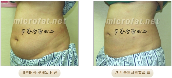 두한성형외과 지방흡입 - 부위별 안전 지방흡입 관련 이미지 13