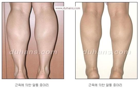 [두한성형외과 경쟁력 멀티 종아리성형] - [여러 가지 종아리 성형 방법의 단점 안내] 관련 이미지 3