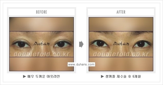 [두한성형외과 경쟁력 쌍꺼풀 재수술, 극한 눈재수술] - [쌍꺼풀 재수술, 극한 눈재수술 관련 자주하는 질문과 답변] 관련 이미지 12
