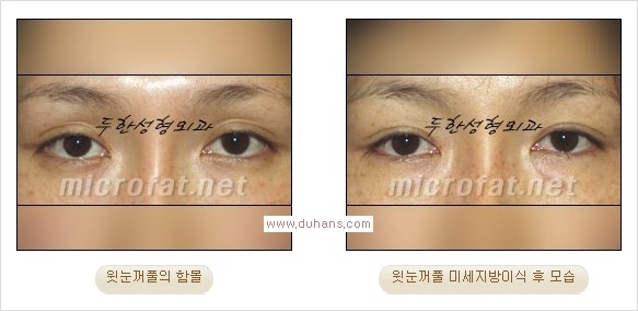 [두한성형외과 경쟁력 쌍꺼풀 재수술, 극한 눈재수술] - [어색한 쌍꺼풀 라인을 교정하는 윗눈꺼풀 미세지방이식] 관련 이미지 22