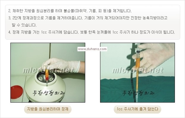 [두한성형외과 경쟁력 쌍꺼풀 재수술, 극한 눈재수술] - [어색한 쌍꺼풀 라인을 교정하는 윗눈꺼풀 미세지방이식] 관련 이미지 3