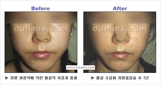 [두한성형외과 경쟁력 얼굴지방흡입] - [통통한 볼살, 두툼한 턱살(턱선)의 지방흡입] 관련 이미지 16