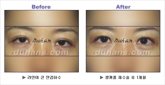 [두한성형외과 경쟁력 쌍꺼풀 재수술] - [안검하수 성형 흔한 질문과 답변 모음] 관련 이미지 7