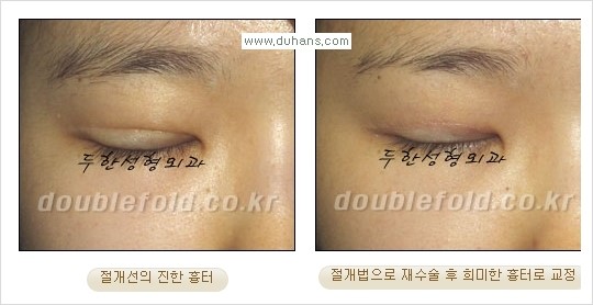 [두한성형외과 경쟁력 쌍꺼풀 재수술] - [쌍꺼풀 절개법 수술 후 쌍꺼풀 흉터선 교정] 관련 이미지 7