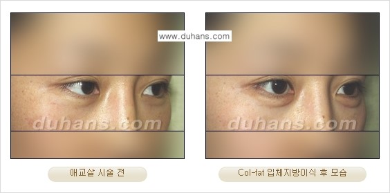 [두한성형외과 경쟁력 미세지방이식] - [탄력있는 피부와 윤곽을 만들어주는 Col-fat 지방이식] 관련 이미지 12