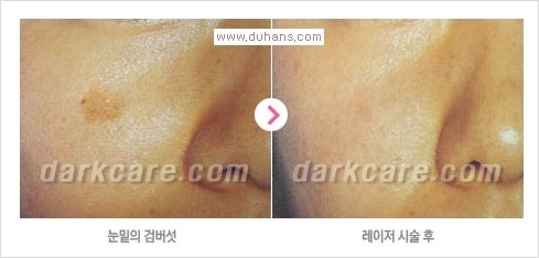 [두한성형외과 경쟁력 눈밑성형] - [다크써클 + 검버섯 레이저 콤비 프로그램 안내] 관련 이미지 10