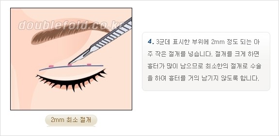 [두한성형외과 경쟁력 쌍꺼풀 재수술, 극한 재수술] - [쌍꺼풀 재수술의 과정 안내 2.] 관련 이미지 7