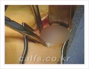 [두한성형외과 경쟁력 멀티종아리성형] -  [종아리 축소술의 여러 가지 종류] 관련 이미지 4
