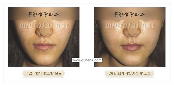 [두한성형외과 경쟁력 윤곽성형] - [볼, 볼살 지방이식] 관련 이미지 17
