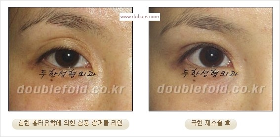 [두한성형외과 경쟁력 쌍꺼풀 재수술 스페셜] - [망가진 라인을 교정하는 극한 재수술] 관련 이미지 7